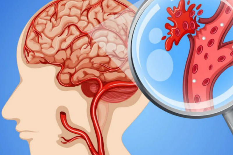 ¿Cómo identificar los síntomas de un accidente cerebrovascular?