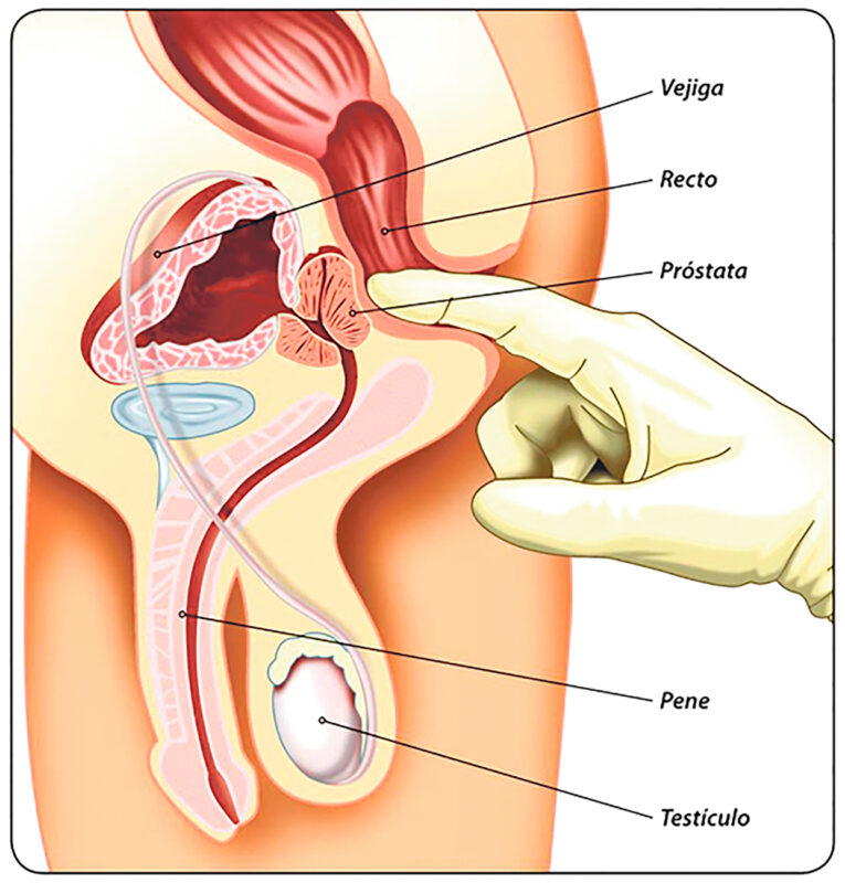 Hay que realizarse el examen de tacto rectal a partir de los 40 años para prevenir este padecimiento.