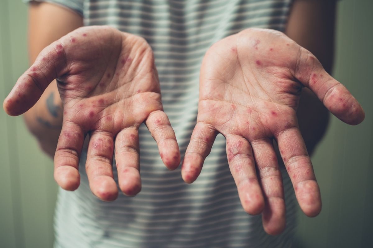 Alertan riesgo en Costa Rica por aumento de sarampión en Latinoamérica